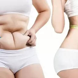 liposuction in Riyadh Saudia